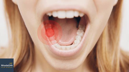 Cách xử trí khi mọc răng khôn bị đau